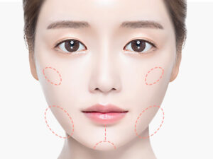 브이라인 얼굴지방흡입 | 워나성형외과